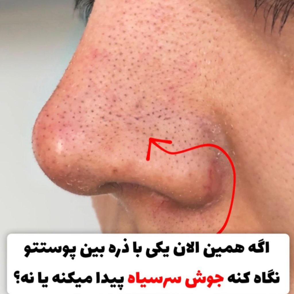 چسب رفع جوش سرسیاه لانبنا